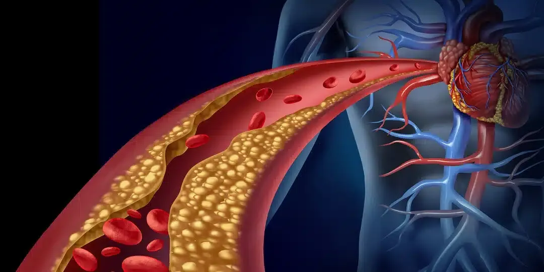 Single-dose gene therapy slashes ‘bad’ cholesterol by up to 62%, landmark study showed