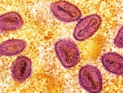 Mandaluyong confirms mpox case, launches contact tracing
